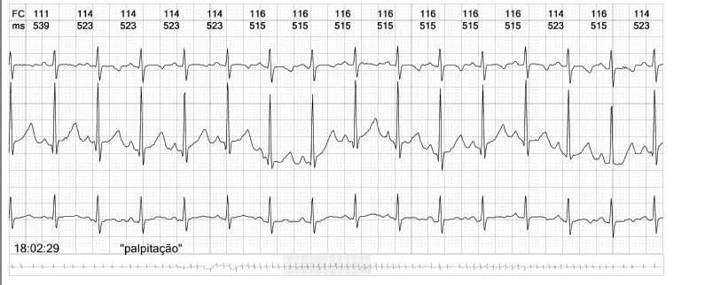 imagem de eletrocardiograma com palpitação